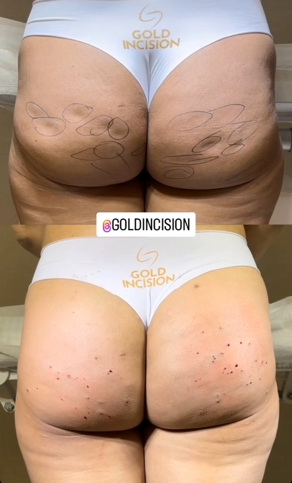 Registro comparativo de GoldIncision fornecido pela clínica.