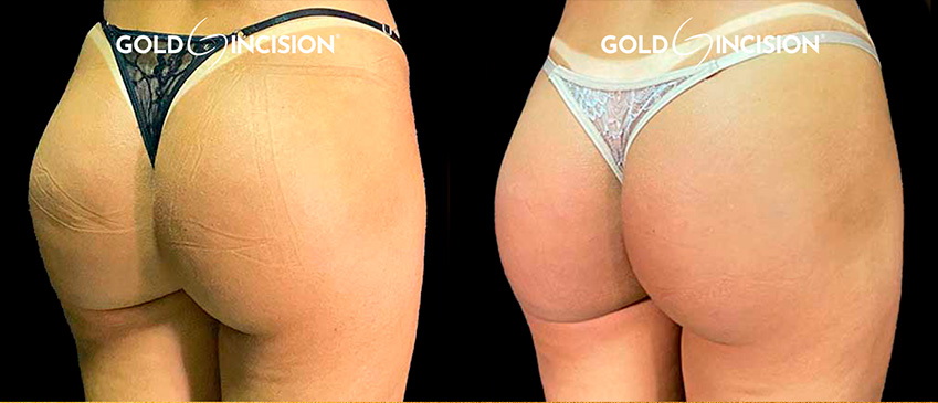 Comparação de antes e depois publicada pela Dra. Denise Ozores — caso 1.