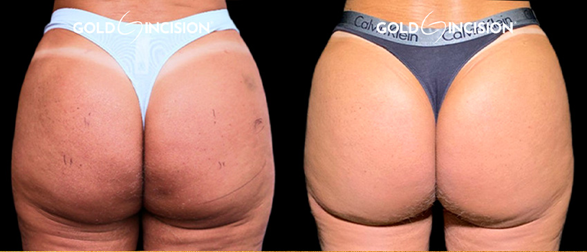 Comparação de antes e depois publicada pela Dra. Denise Ozores — caso 2.