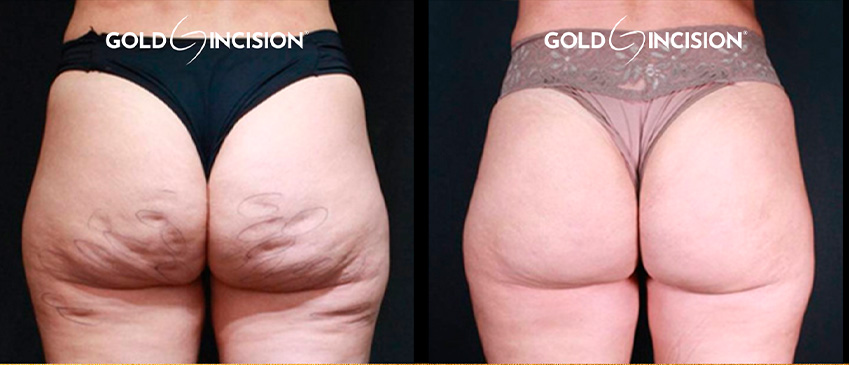 Comparação de antes e depois publicada pela Dra. Denise Ozores — caso 3.