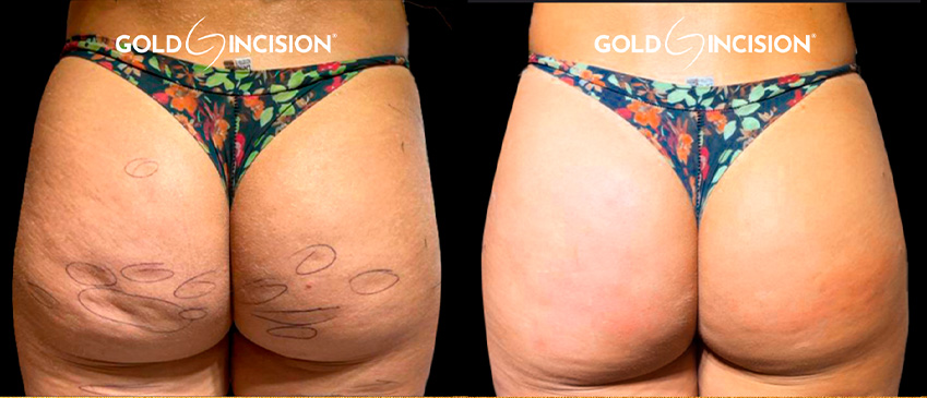 Comparação de antes e depois publicada pela Dra. Denise Ozores — caso 5.